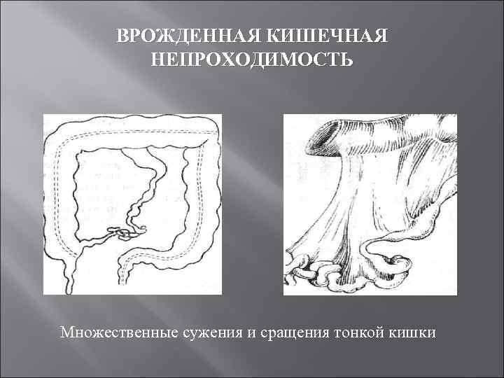 ВРОЖДЕННАЯ КИШЕЧНАЯ НЕПРОХОДИМОСТЬ Множественные сужения и сращения тонкой кишки 