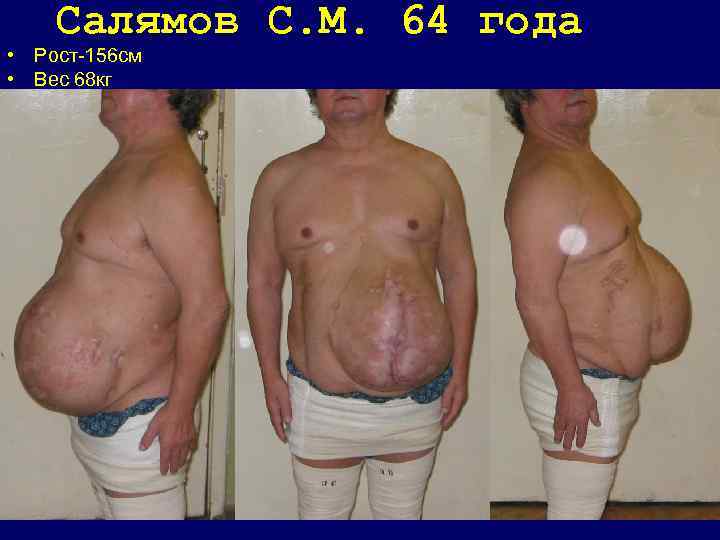 Салямов C. М. 64 года • Рост-156 см • Вес 68 кг • 12.