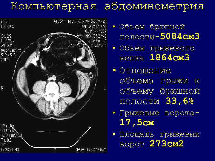 Полость количество. Объем брюшной полости кт. Кт жидкость в брюшной полостт. Жидкость в брюшной полости на кт. Объем брюшинной полости.