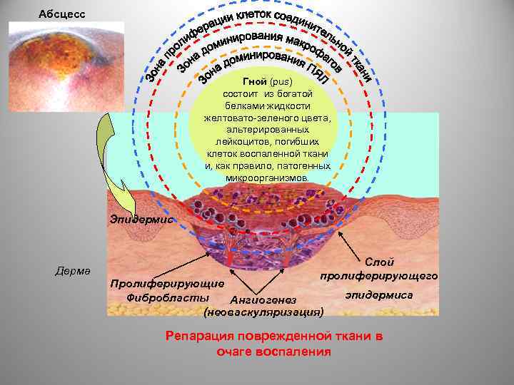 Абсцесс Гной (pus) состоит из богатой белками жидкости желтовато-зеленого цвета, альтерированных лейкоцитов, погибших клеток