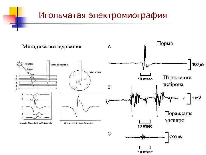 Игольчатая электромиография Методика исследования Норма Поражение нейрона Поражение мышцы 