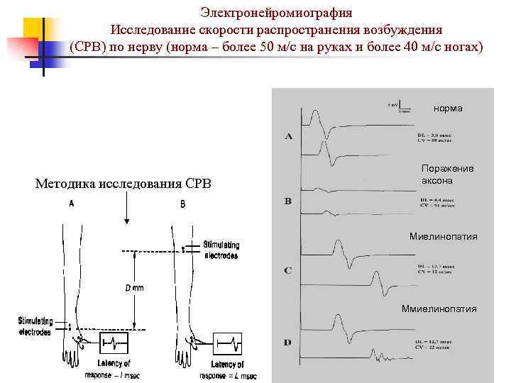 Электронейромиография Исследование скорости распространения возбуждения (СРВ) по нерву (норма – более 50 м/с на