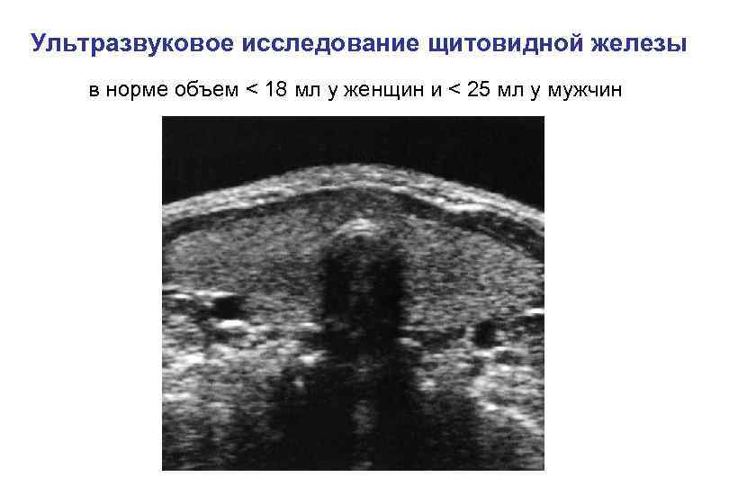 Ультразвуковое исследование щитовидной железы в норме объем < 18 мл у женщин и <