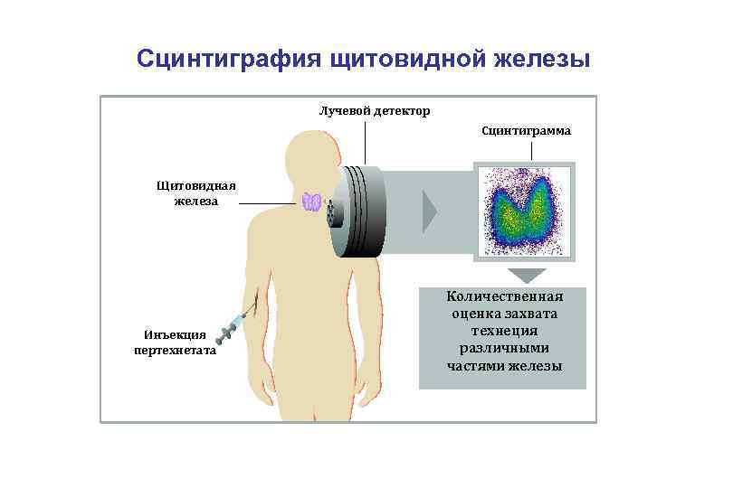 Сцинтиграфия щитовидной железы Лучевой детектор Сцинтиграмма Щитовидная железа Инъекция пертехнетата Количественная оценка захвата технеция