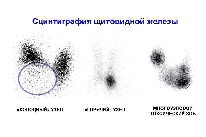 Сцинтиграфия щитовидной железы «ХОЛОДНЫЙ» УЗЕЛ «ГОРЯЧИЙ» УЗЕЛ МНОГОУЗЛОВОЙ ТОКСИЧЕСКИЙ ЗОБ 