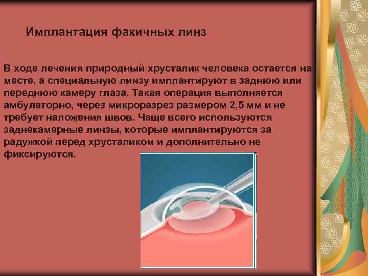 Имплантация факичных линз В ходе лечения природный хрусталик человека остается на месте, а специальную