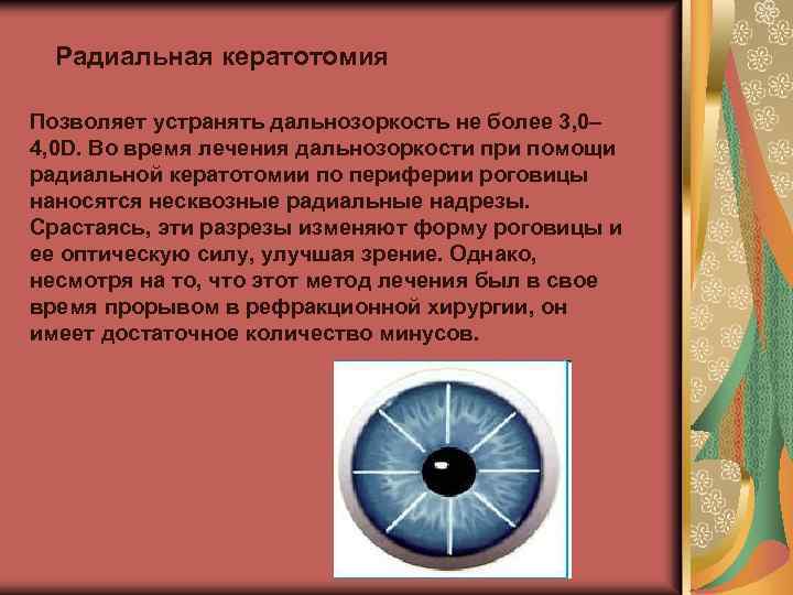 Радиальная кератотомия Позволяет устранять дальнозоркость не более 3, 0– 4, 0 D. Во время