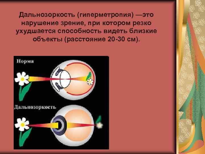 Гиперметропия высокой степени у детей