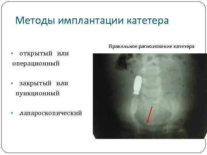Методы имплантации катетера открытый или операционный • закрытый или пункционный • • лапароскопический Правильное
