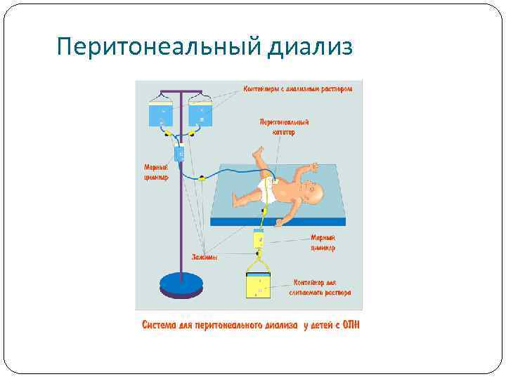 Перитонеальный диализ 