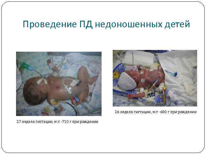 Проведение ПД недоношенных детей 26 неделя гистации, м. т -680 г при рождении 27