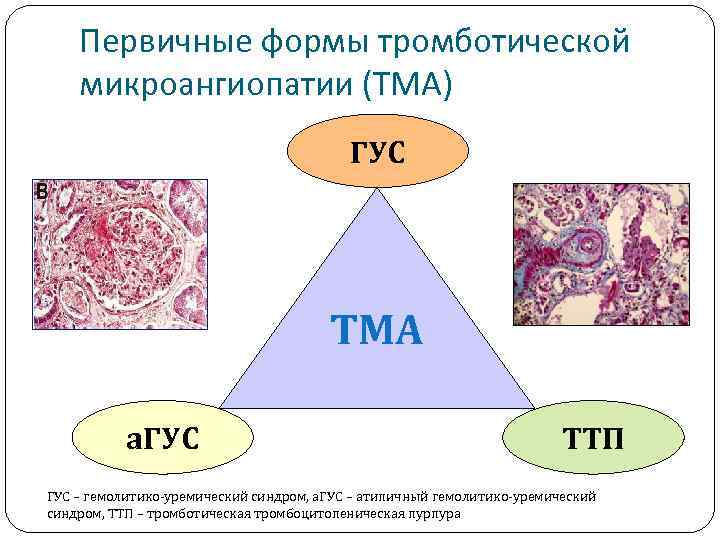 Первичные формы тромботической микроангиопатии (ТМА) ГУС ТМА а. ГУС ТТП ГУС – гемолитико-уремический синдром,