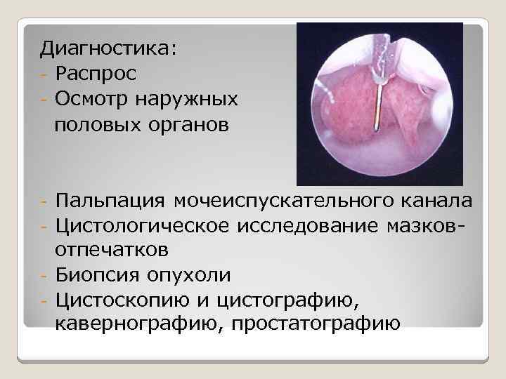 Диагностика: - Распрос - Осмотр наружных половых органов Пальпация мочеиспускательного канала - Цистологическое исследование