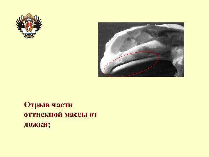 Отрыв части оттискной массы от ложки; 