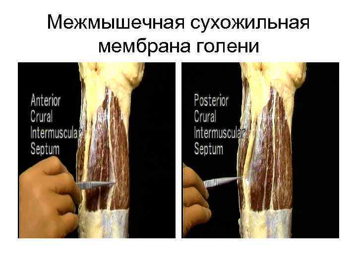 Межмышечная сухожильная мембрана голени 