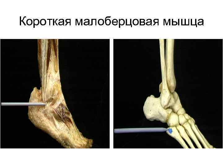 Короткая малоберцовая мышца 