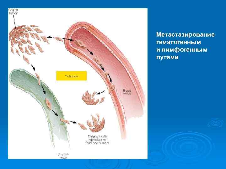 Метастазирование гематогенным и лимфогенным путями 