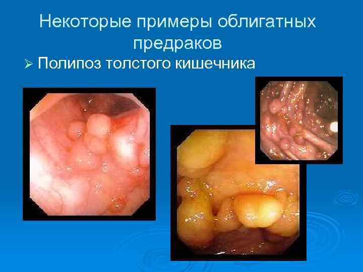 Некоторые примеры облигатных предраков Ø Полипоз толстого кишечника 