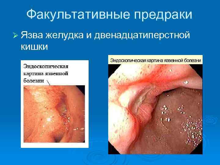 Факультативные предраки Ø Язва желудка и двенадцатиперстной кишки 