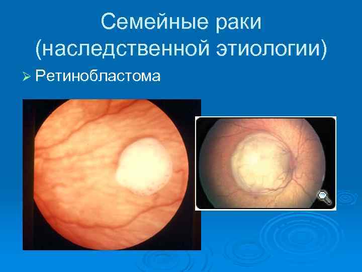 Семейные раки (наследственной этиологии) Ø Ретинобластома 