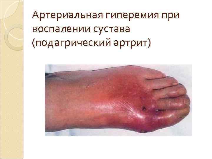 Артериальная гиперемия при воспалении сустава (подагрический артрит) 