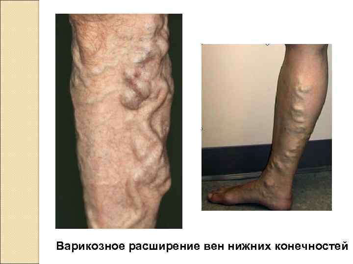 Варикозное расширение вен нижних конечностей 