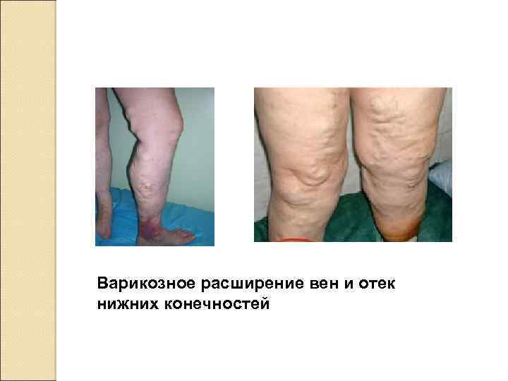 Варикозное расширение вен и отек нижних конечностей 
