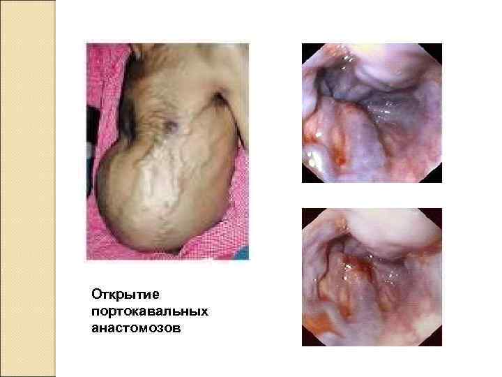 Открытие портокавальных анастомозов 