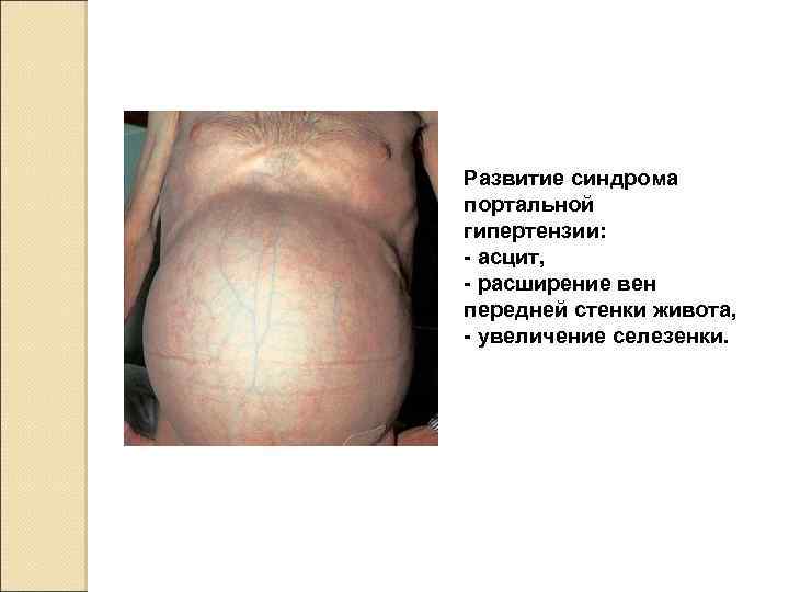 Развитие синдрома портальной гипертензии: - асцит, - расширение вен передней стенки живота, - увеличение