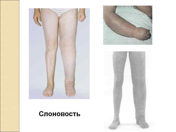 Слоновость 