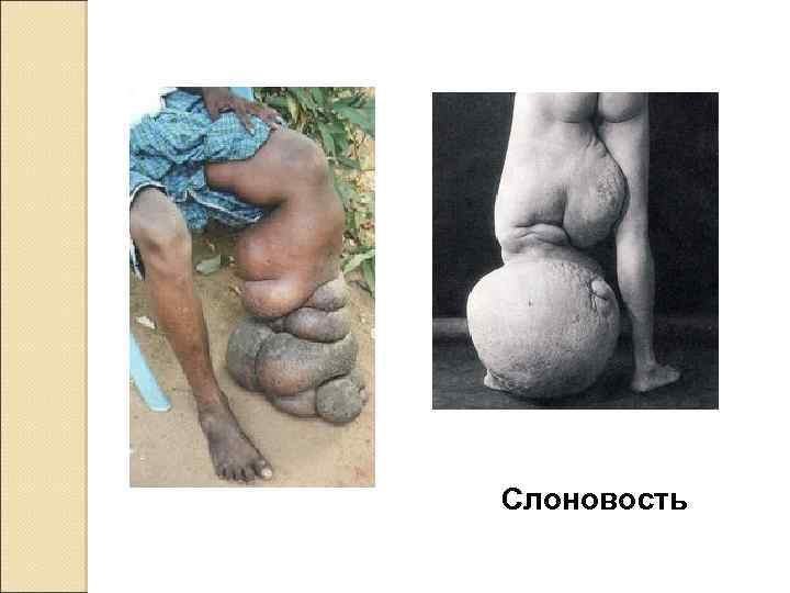 Слоновость 