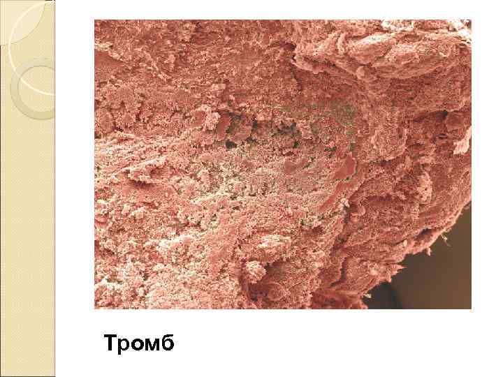 Тромб 
