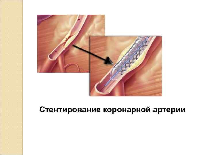 Стентирование коронарной артерии 