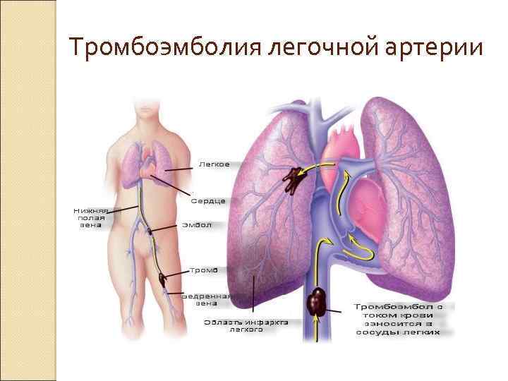 Тромбоэмболия легочной артерии 