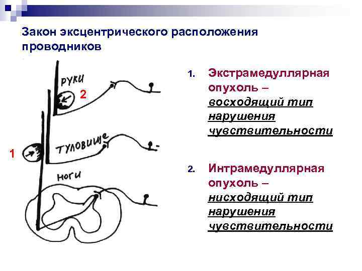 Закон эксцентрического расположения проводников 1. Экстрамедуллярная опухоль – восходящий тип нарушения чувствительности 2. Интрамедуллярная
