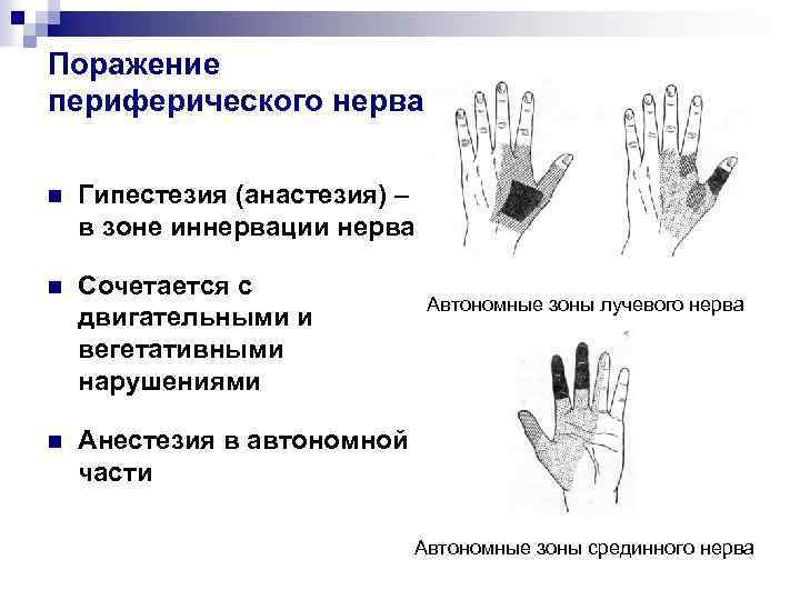 Поражение периферического нерва n Гипестезия (анастезия) – в зоне иннервации нерва n Сочетается с