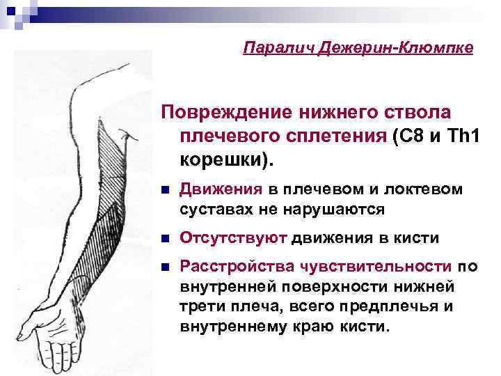 Паралич Дежерин-Клюмпке Повреждение нижнего ствола плечевого сплетения (С 8 и Th 1 корешки). n
