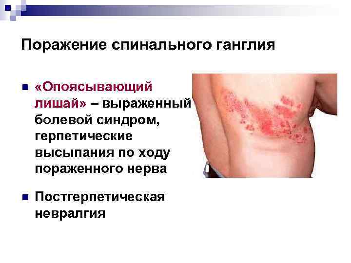 Поражение спинального ганглия n «Опоясывающий лишай» – выраженный болевой синдром, герпетические высыпания по ходу