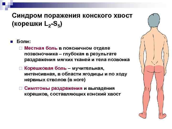 Синдром поражения конского хвоста (корешки L 2 -S 5) n Боли: ¨ Местная боль