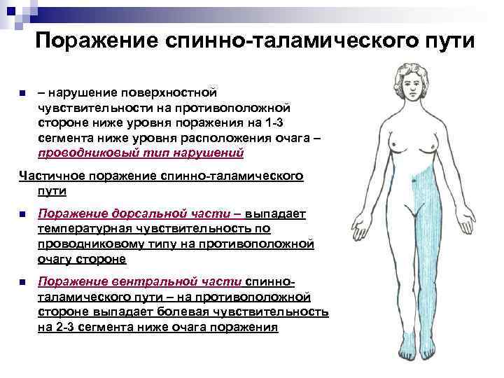 Поражение спинно-таламического пути n – нарушение поверхностной чувствительности на противоположной стороне ниже уровня поражения