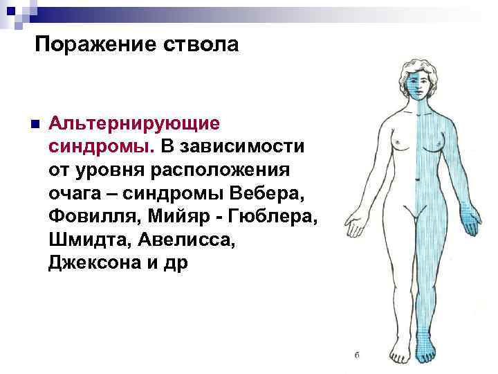 Поражение ствола n Альтернирующие синдромы. В зависимости от уровня расположения очага – синдромы Вебера,