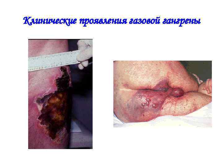 Клинические проявления газовой гангрены 