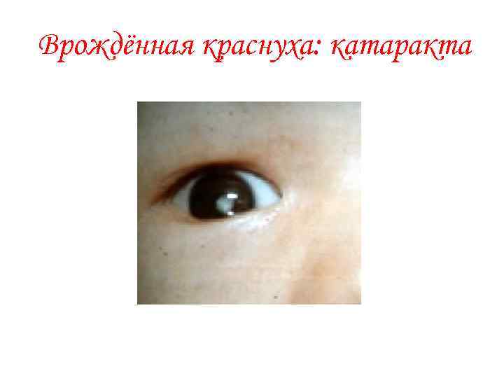 Врождённая краснуха: катаракта 
