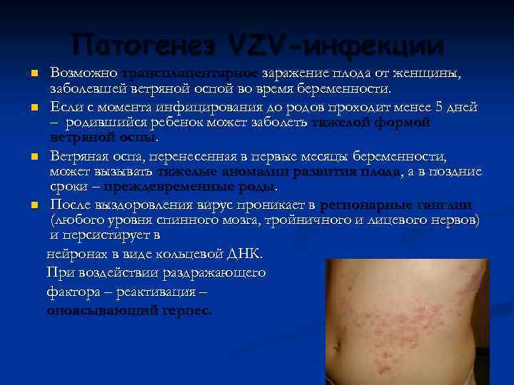 Патогенез VZV-инфекции n n Возможно трансплацентарное заражение плода от женщины, заболевшей ветряной оспой во