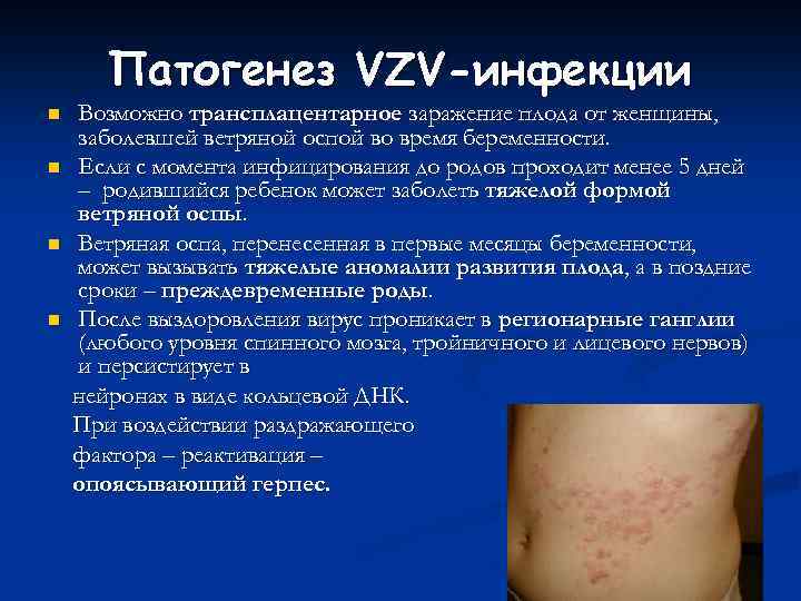 Патогенез VZV-инфекции n n Возможно трансплацентарное заражение плода от женщины, заболевшей ветряной оспой во