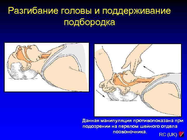 Разгибание головы и поддерживание подбородка Данная манипуляция противопоказана при подозрении на перелом шейного отдела