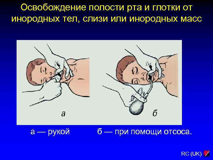 Освобождение полости рта и глотки от инородных тел, слизи или инородных масс а —