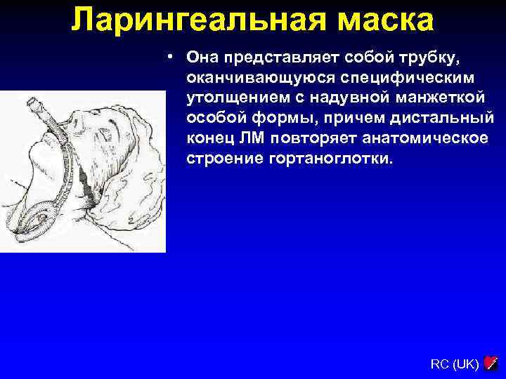 Ларингеальная маска • Она представляет собой трубку, оканчивающуюся специфическим утолщением с надувной манжеткой особой