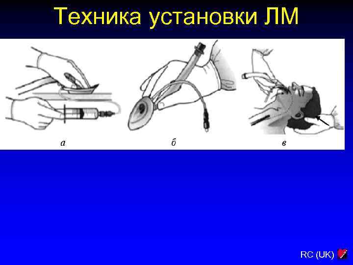 Техника установки ЛМ RC (UK) 