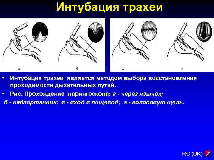 Интубация трахеи • Интубация трахеи является методом выбора восстановления проходимости дыхательных путей. • Рис.